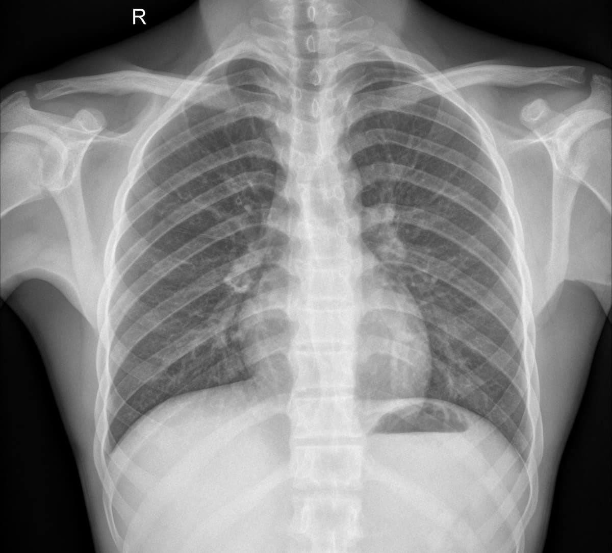 Chest X-Ray Pneumonia Detection